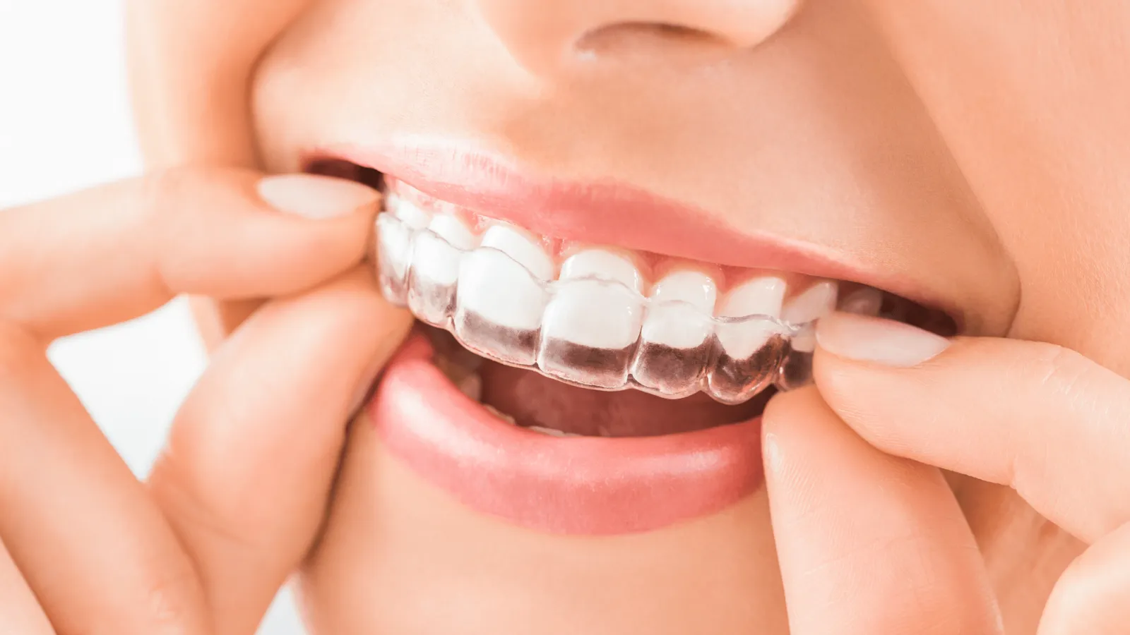 Orthodontic treatment for a healthier smile