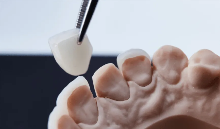 Illustration comparing a dental crown to a dental veneer
