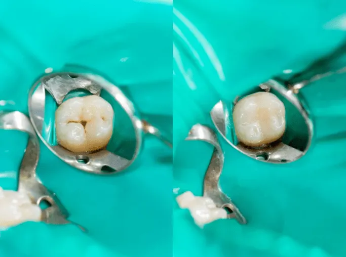 Dental sealants illustration showing protected tooth grooves