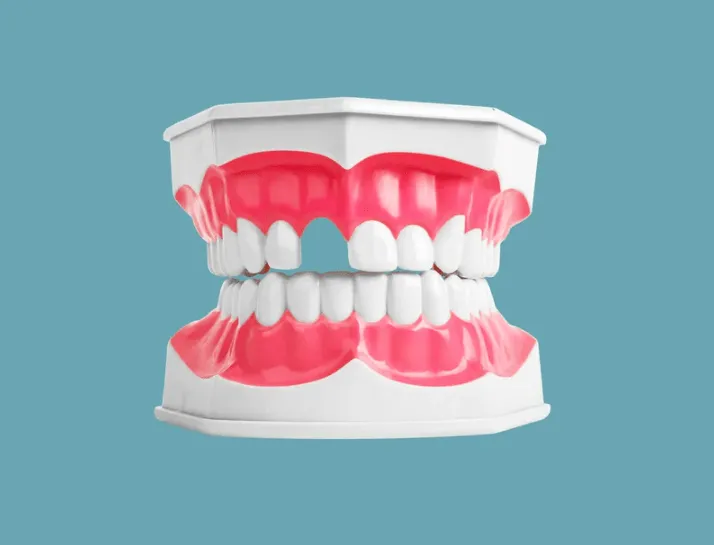 Illustration comparing tooth replacement options