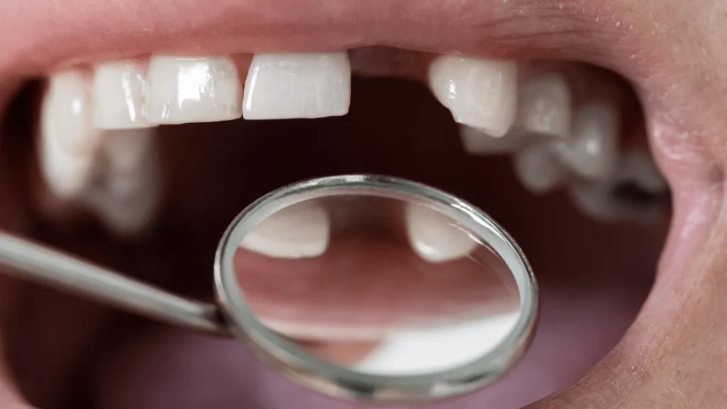 Illustration of a missing tooth in a dental exam