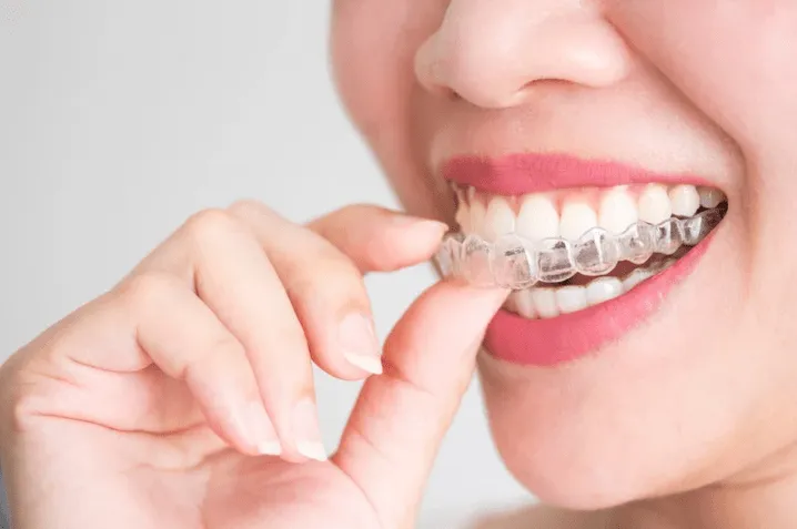 Person placing a clear dental aligner over their teeth
