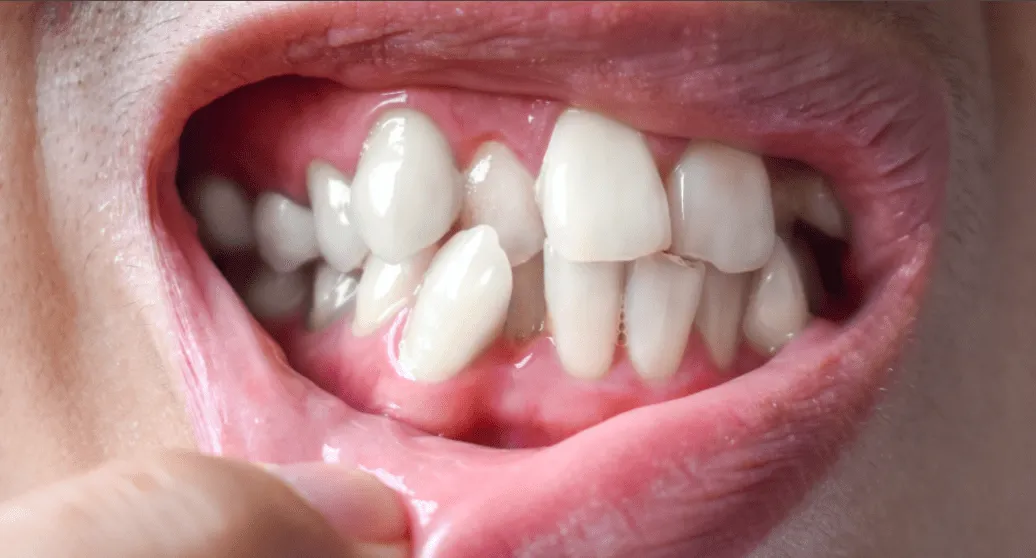 Illustration of an overbite compared to a properly aligned bite