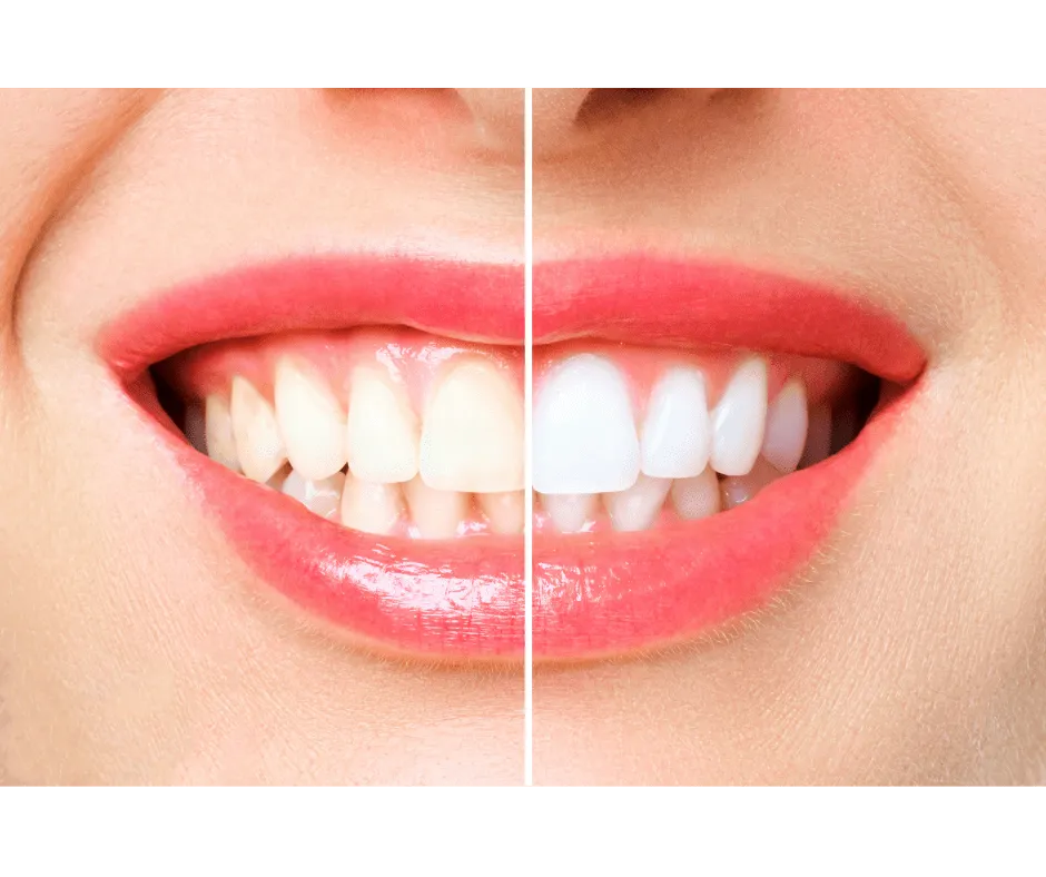 Teeth whitening treatment for a brighter smile