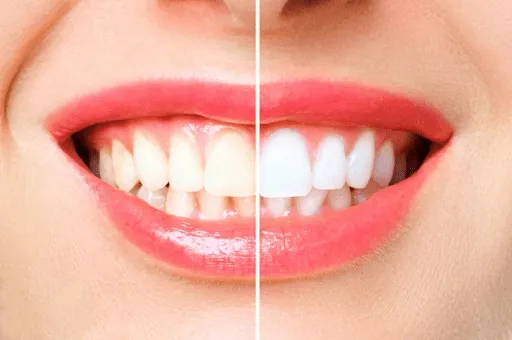 Illustration of how to whiten your smile