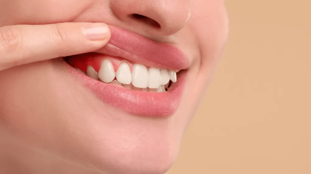 Person pulling back their lip to show an inflamed, bleeding gum