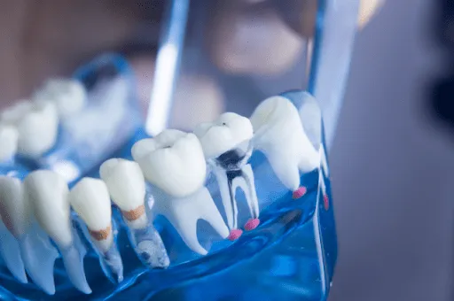 Illustration of clean teeth with plaque removed