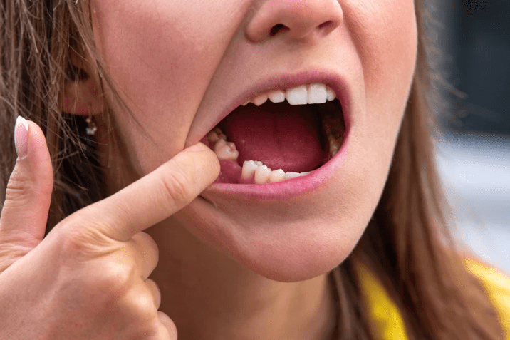woman with missing tooth