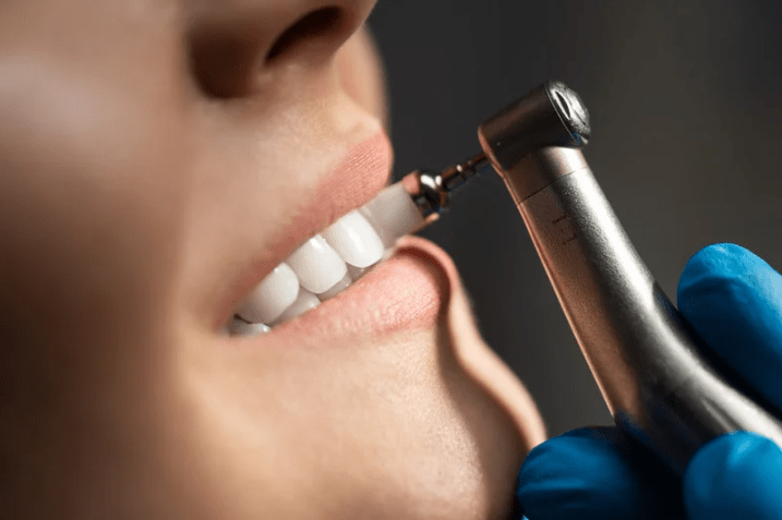 dental prophylaxis cleaning