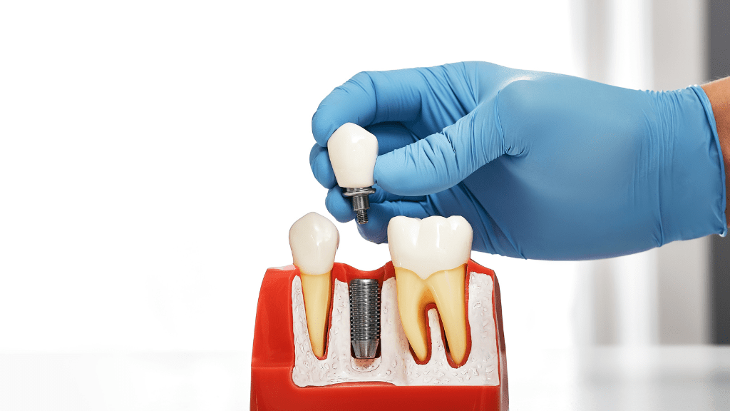 The Long-Term Benefits of Dental Implants