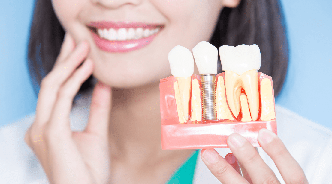 a lady smiling with dental implants